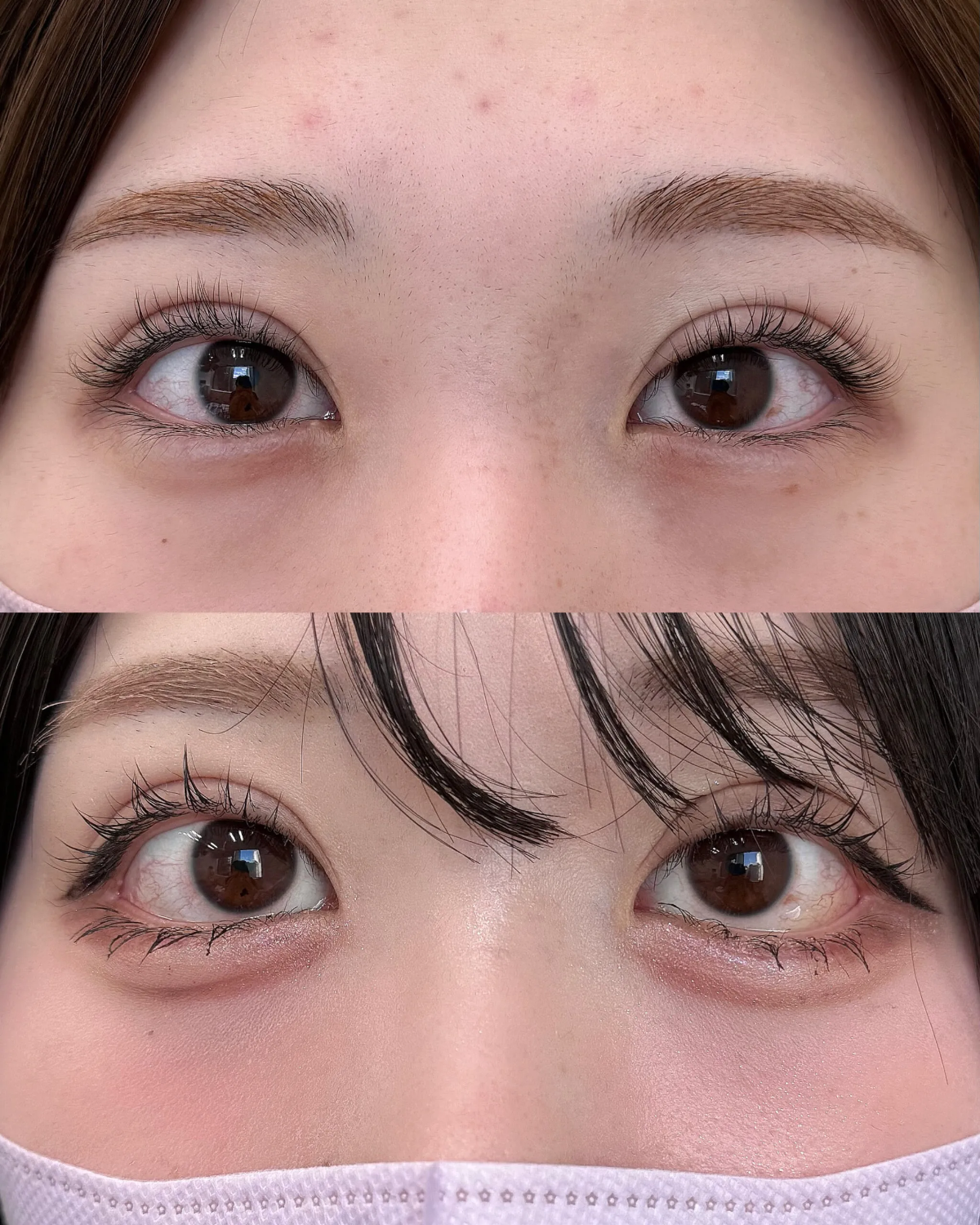 たれ目形成で目の左右のバランスを整える