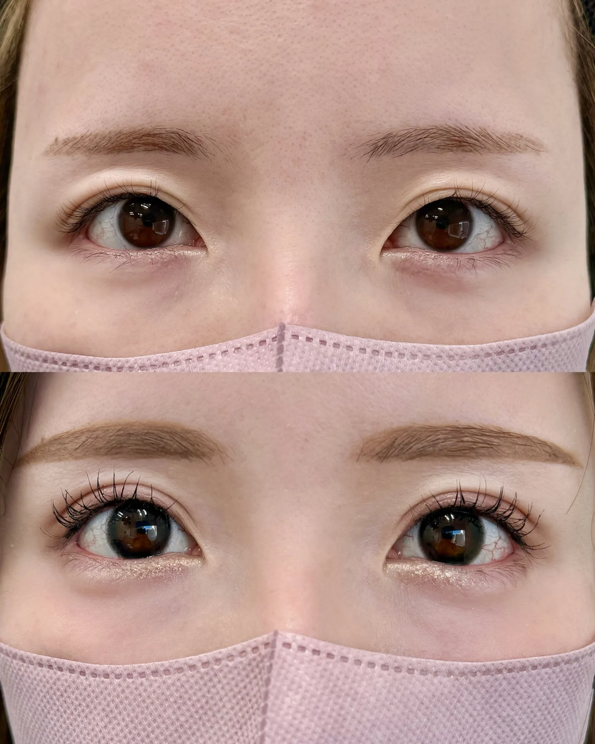 睫毛上皮膚たるみ取りで、二重幅を広げてもまつ毛のキワが見えるように