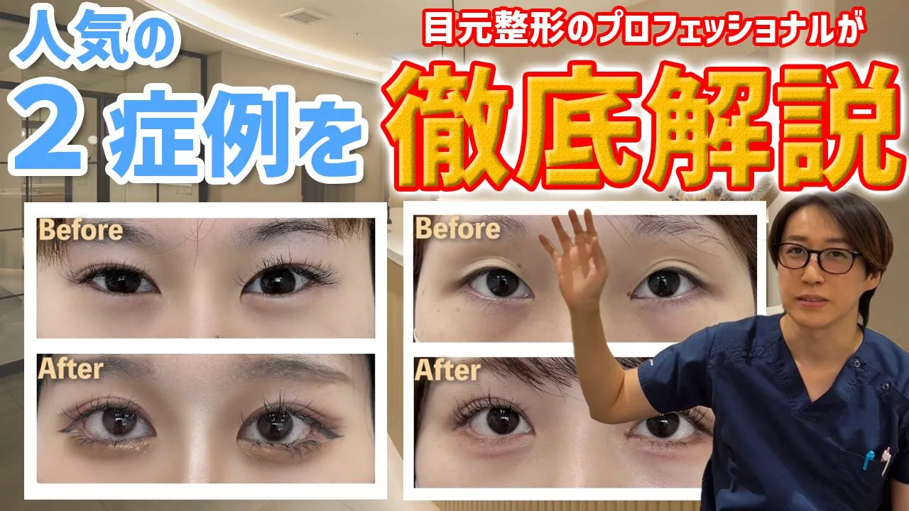 目元切開を考えている人は見て！【目上切開、目頭切開、たれ目形成、目尻切開、外科的涙袋形成、目尻靭帯移動】