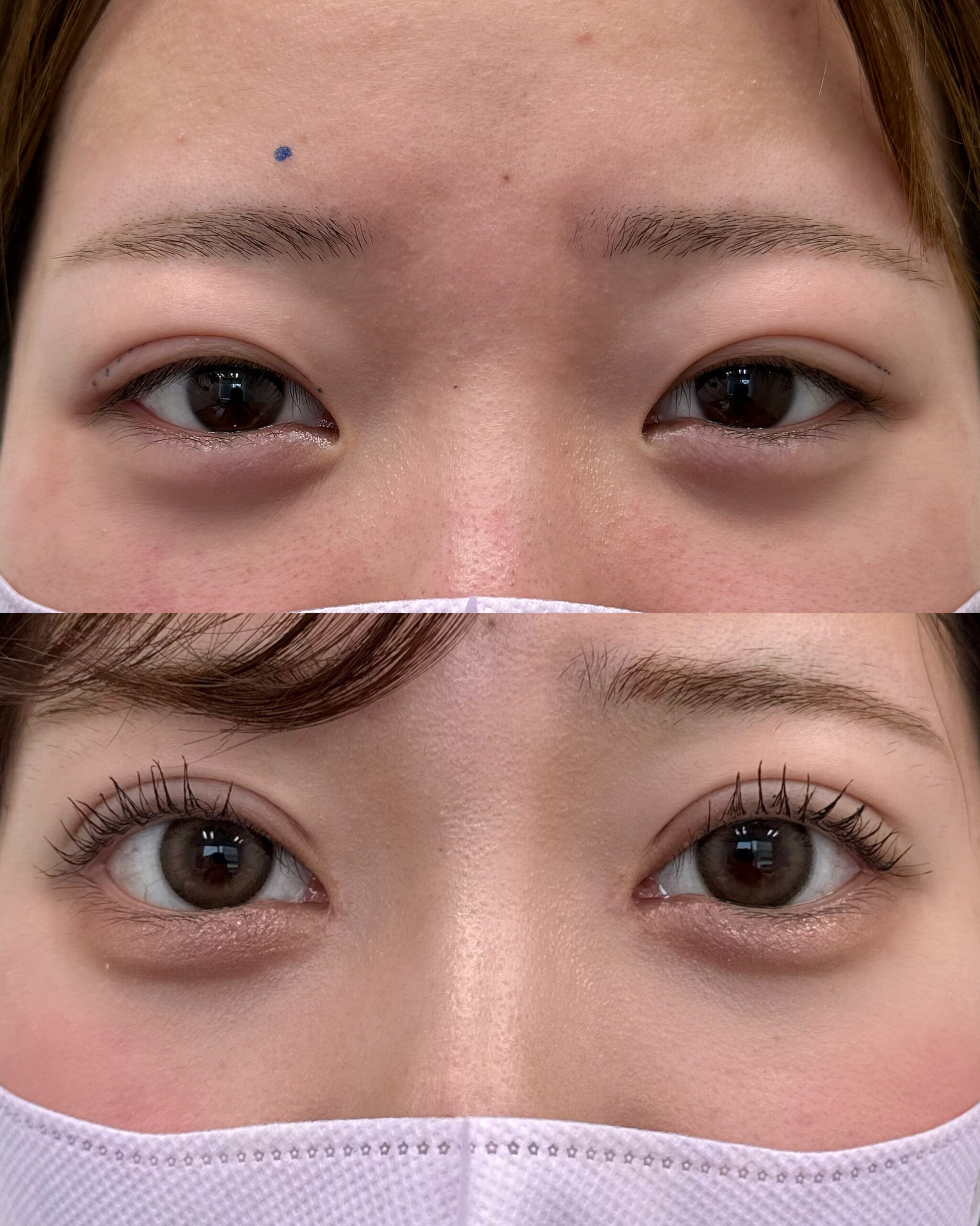 全切開二重+たるみ取り併用+目頭切開