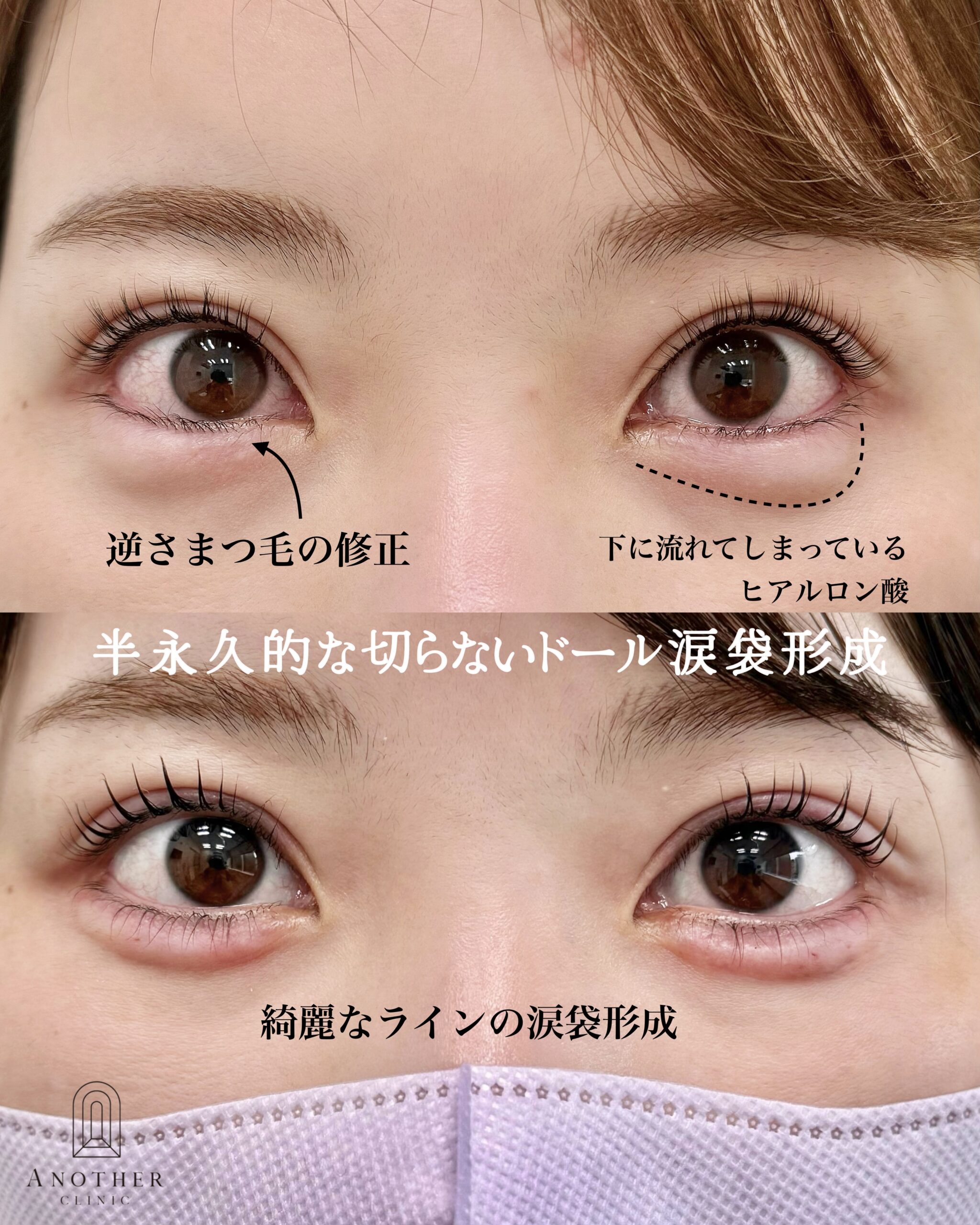 外科的涙袋形成(縫合式)+ヒアルロン酸
