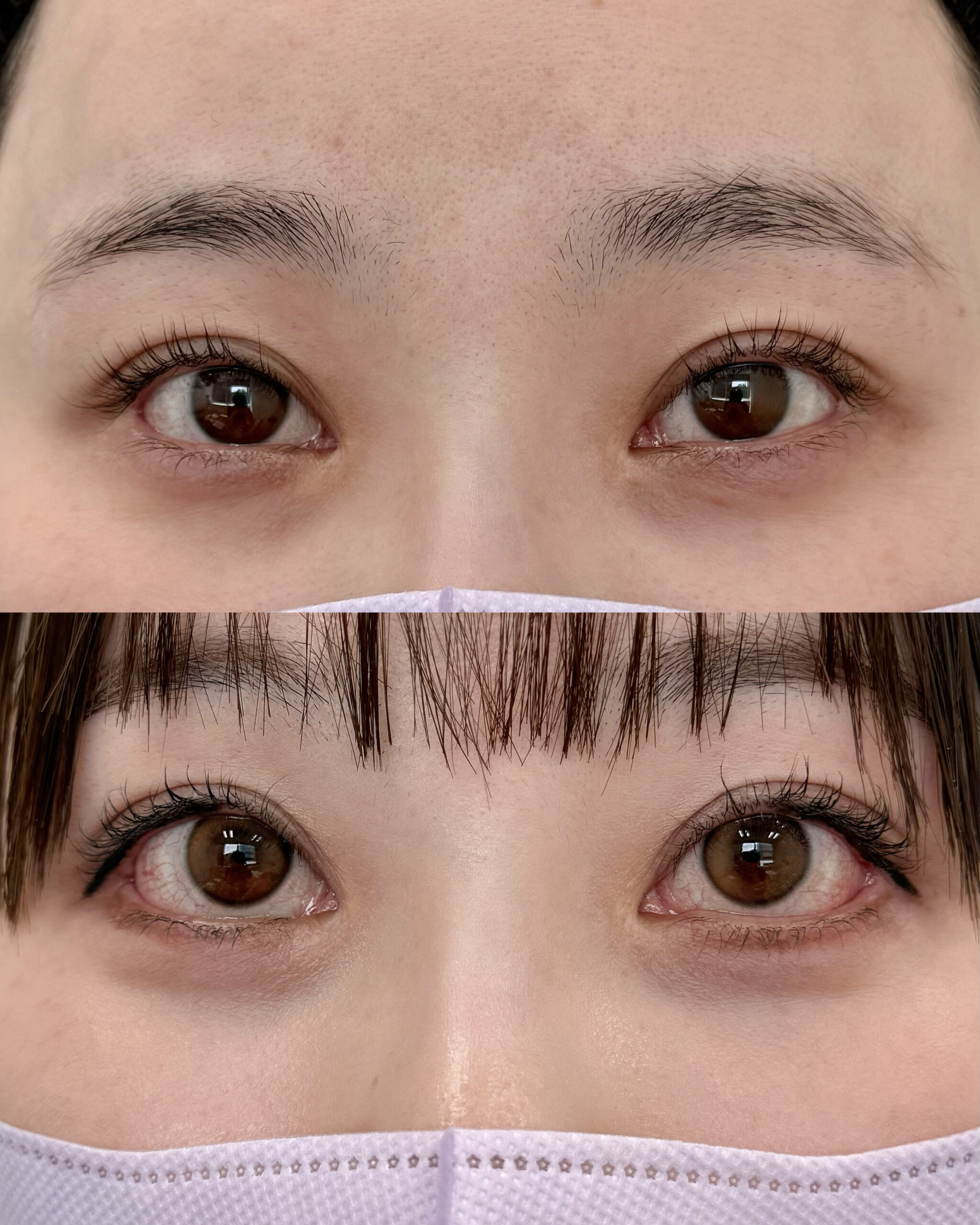 たれ目形成で下まぶたのツリ感を減らす