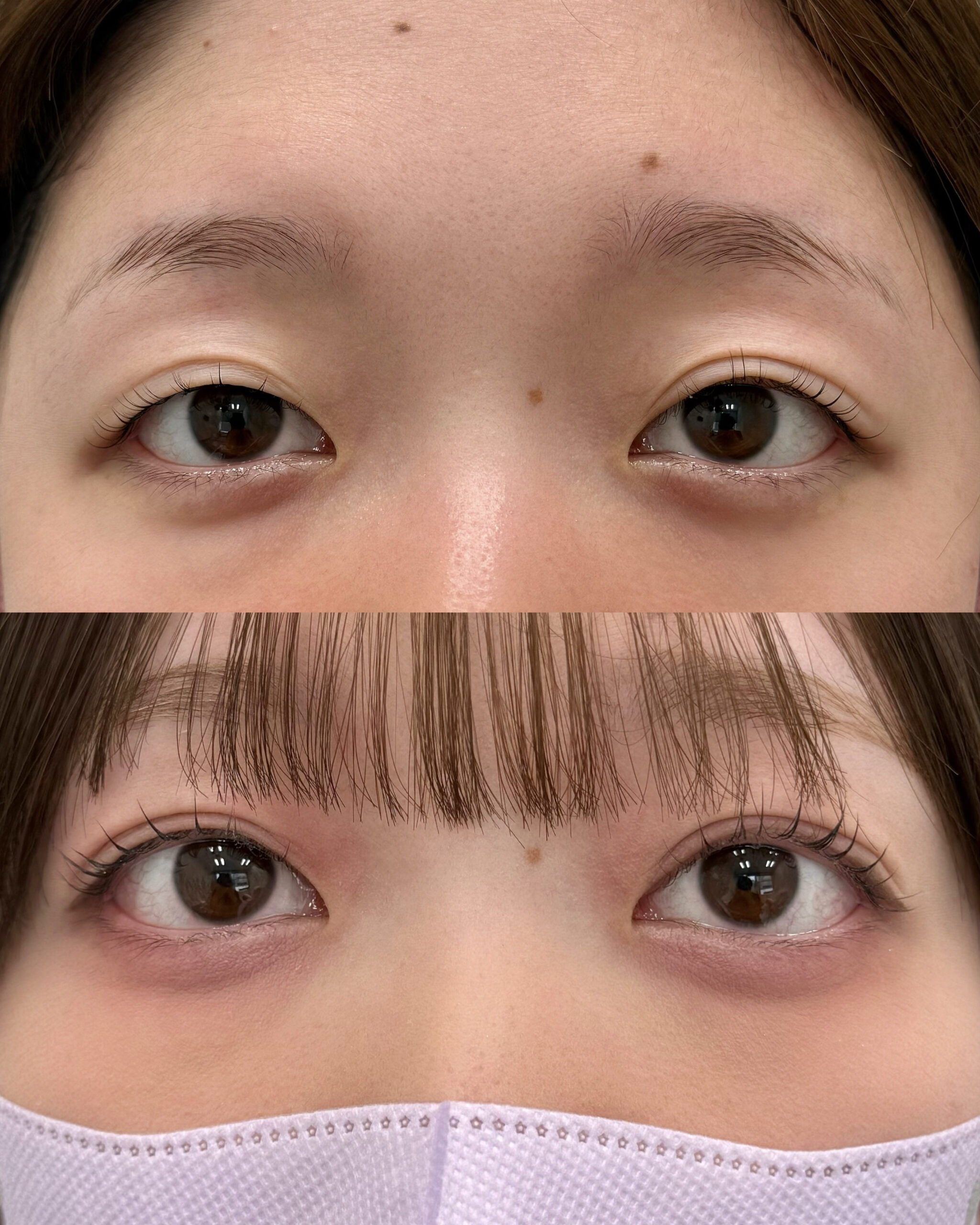 自然な雰囲気の全切開二重