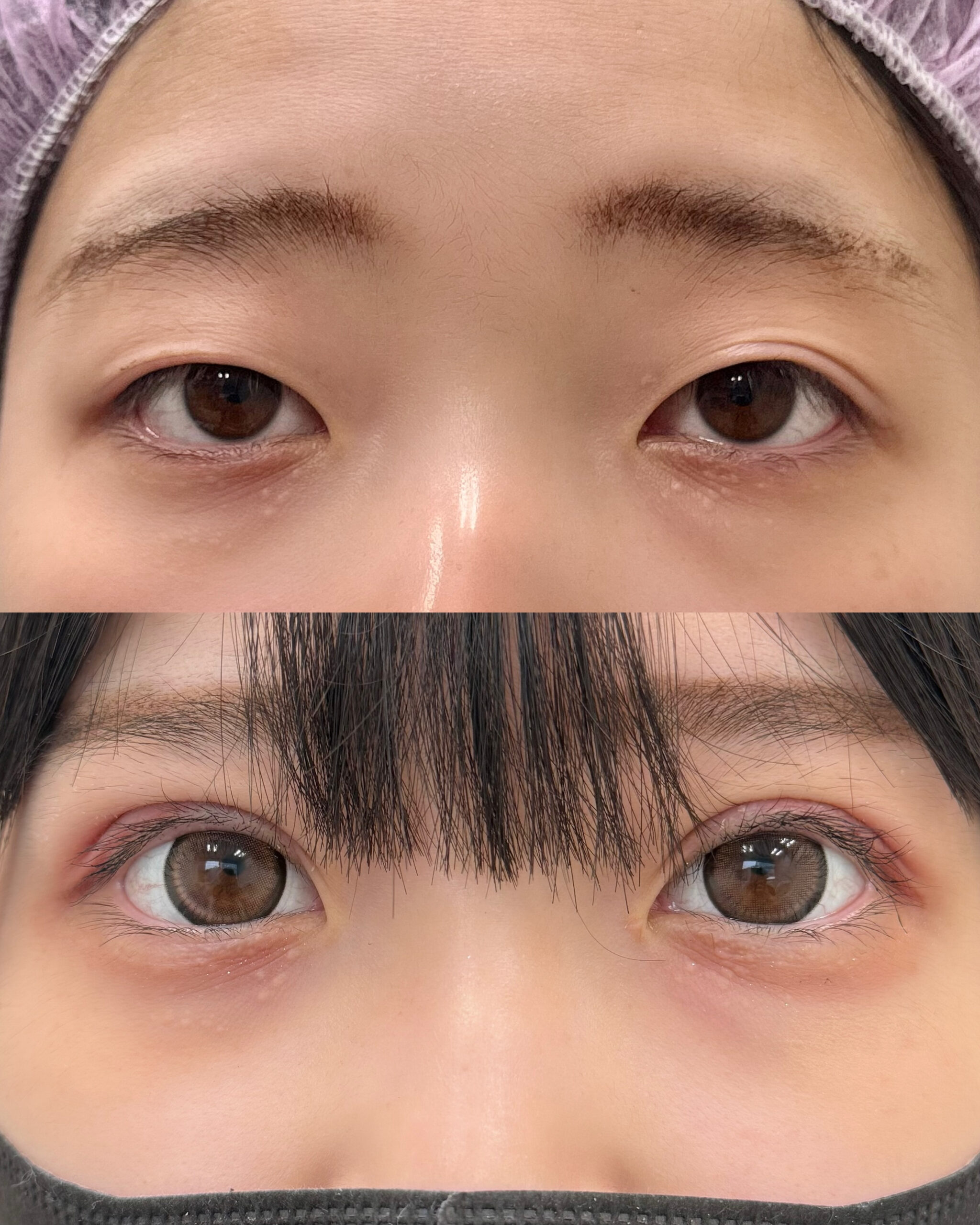 まつ毛のキワが見える二重整形