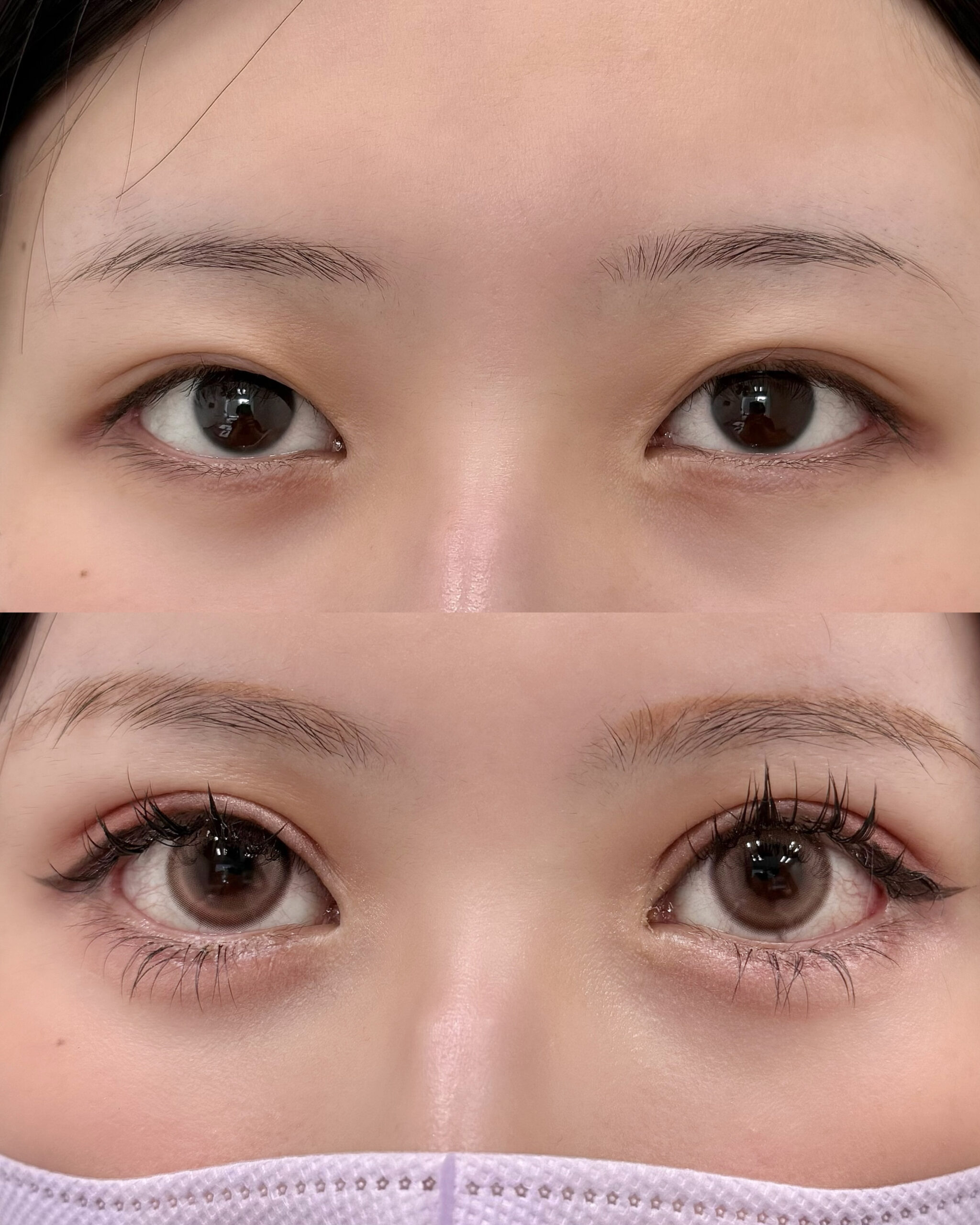 全切開+たれ目形成