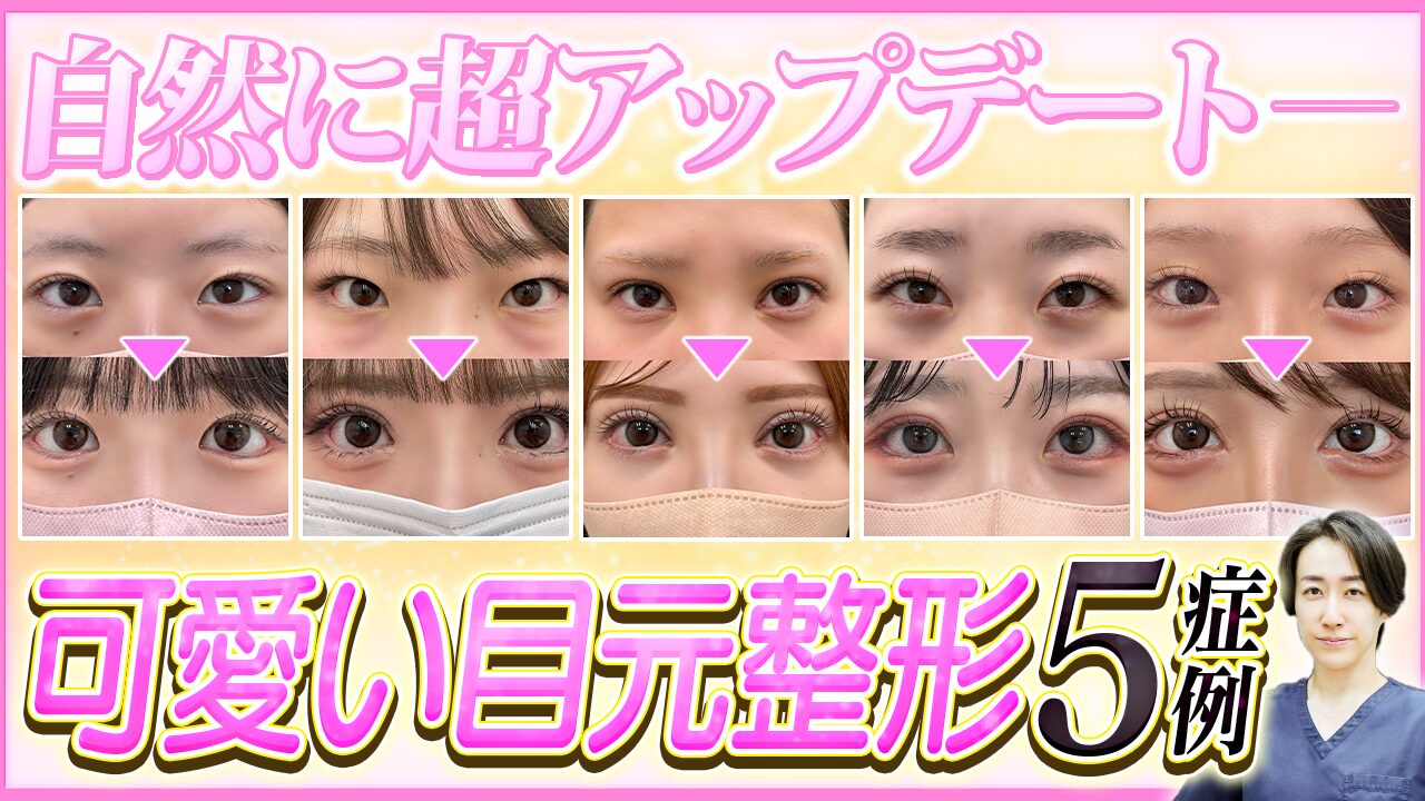 今回は【垢抜け整形】タレ目形成でナチュラルな可愛い大きな目元を手に入れる！目元整形のプロが5名の症例を徹底解説についてお話させていただきました。<br />
<br />
当院でも特に人気で大きく垢抜けを叶えた症例でそれぞれ行った施術（タレ目形成、目頭切開、二重埋没・二重全切開、目尻切開、外科的涙袋形成術など）網羅的にまとめたので是非最後までご覧ください♪