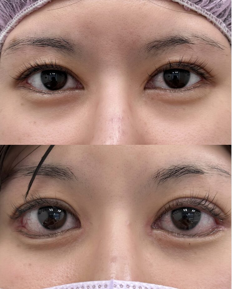 蒙古襞形成+たれ目形成で優しい目つきに！