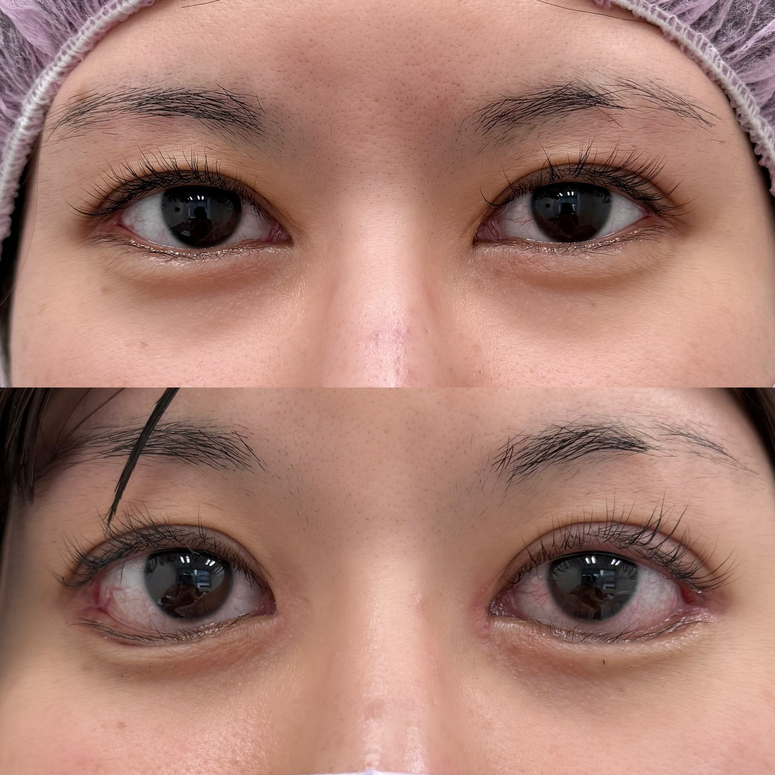 蒙古襞形成+たれ目形成で優しい目つきに！