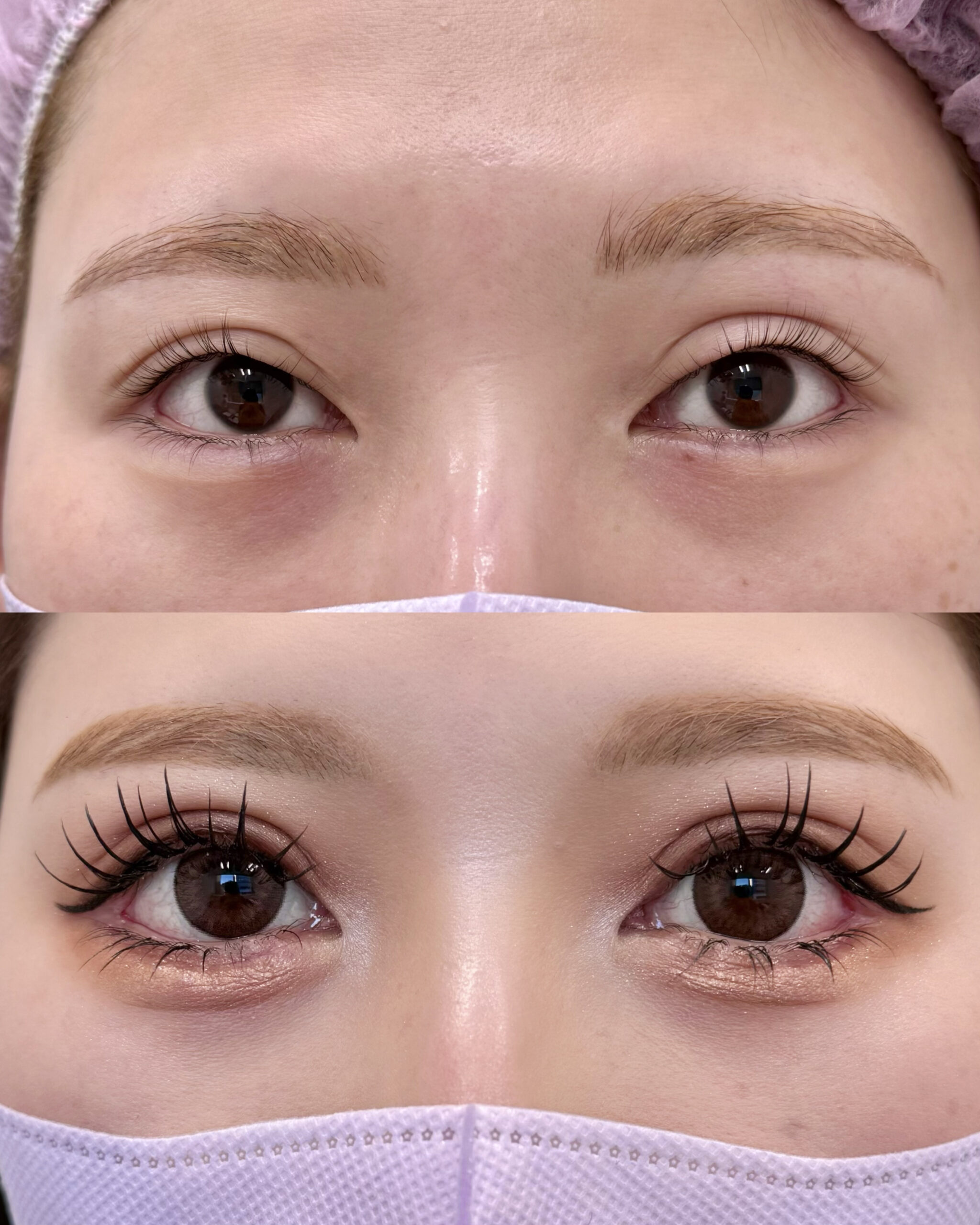 ３方向に目元拡大 & 全切開後のハム目修正｜ハム目修正は睫毛上皮膚切除のみで済む可能性も解説