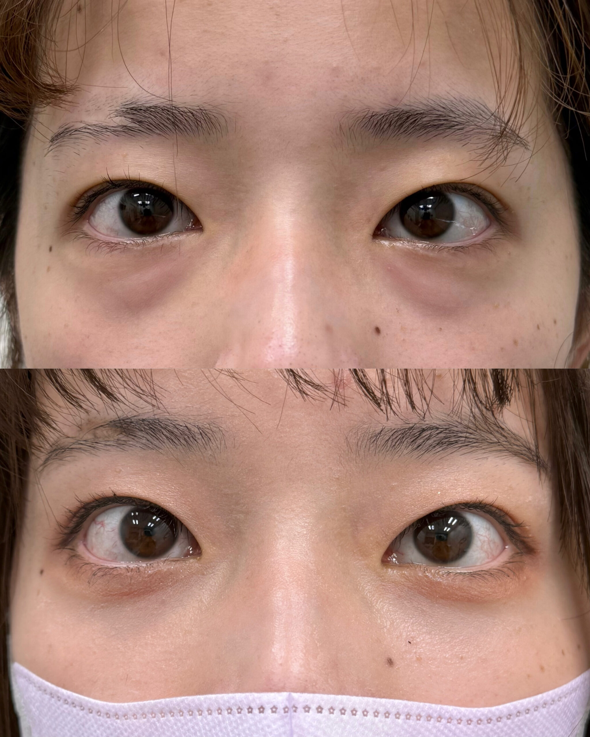 20代女性 切らないクマ取り+脂肪注入(目の下~ゴルゴライン)+外科的涙袋形成(脂肪注入)の症例