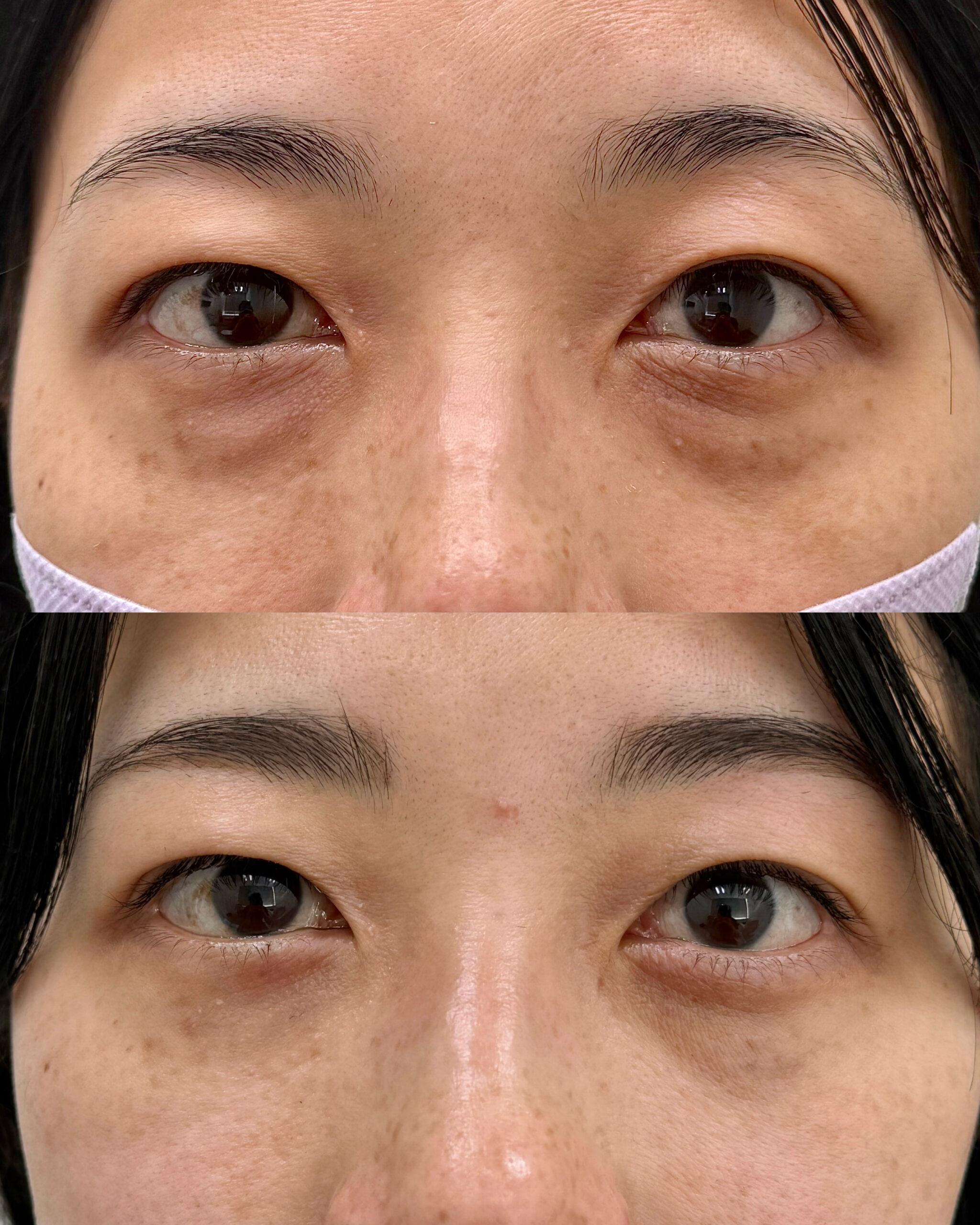 30代の裏ハムラの症例