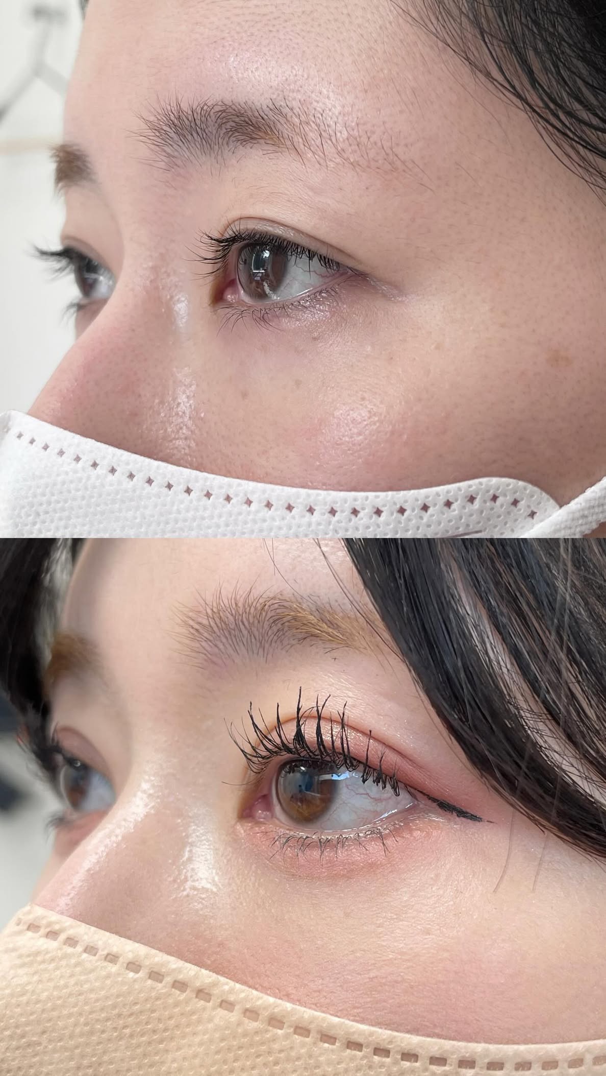 【斜め45度から目を大きく魅せる！】目尻切開+たれ目形成の横顔の変化